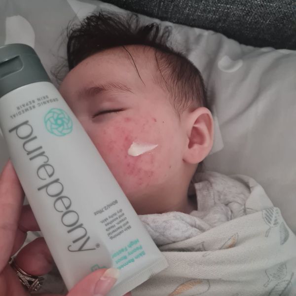 baby with nz eczema cream on face to naturally heal