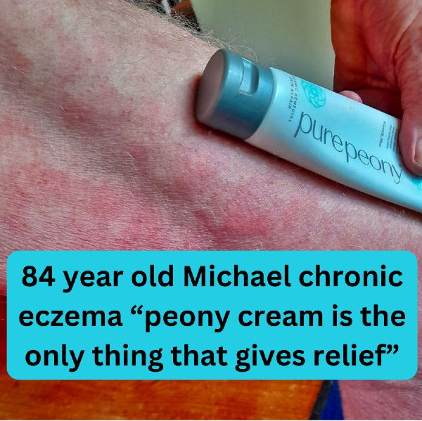 micheal with chronic eczema uses natural cream to get relief from itchy skin