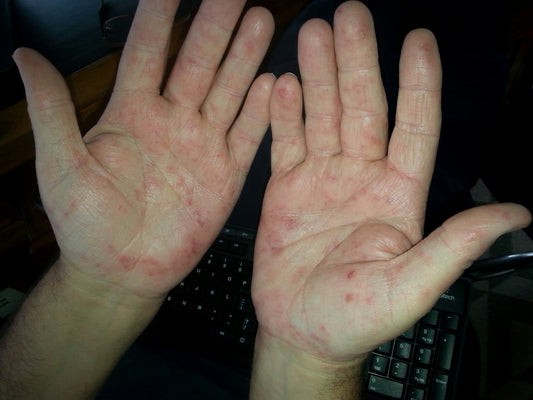 The Essential Guide to Hand Eczema
