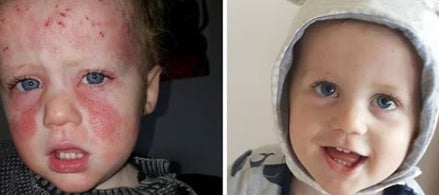 Eczema in Toddlers: How Pure Peony Can Help Your Little One Feel Comfortable Again