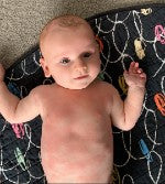 Best Baby Bundles - Treat Eczema Naturally