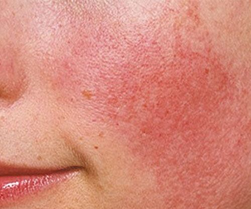 Rosacea Symptoms and Steps to Treat and Prevent