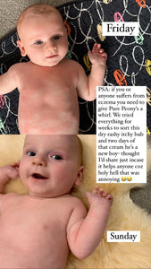 baby eczema healed